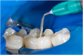 Установка 2-х пломб